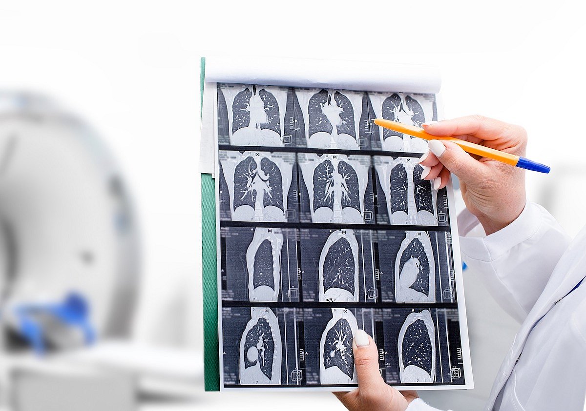 Racial Disparities Persist In Lung Cancer Treatment, Study Finds